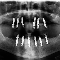 The Dental Equation - Dental Implants. 3D CT Scan.
