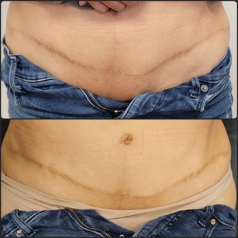 Defined Visage - Scar Correction with Procell serum.  Softens scar tissue and lightens the hyperpigmentation. - Eyebrow Services Near Me - Long Beach, California