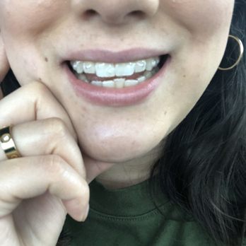 Barney M Hom, DDS - First set of Invisalign - Orthodontists Near Me - Manhattan Beach, California Barney M Hom, DDS - First set of Invisalign - Orthodontists Near Me - Manhattan Beach, California