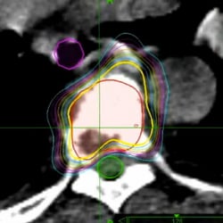 Anova Cancer Care