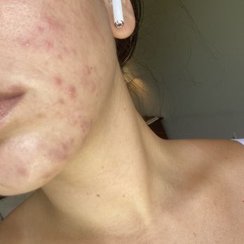 Facial Lounge - FACE 2 MONTHS AFTER FACIAL AND CONTINUAL USE OF PRODUCTS RECOMMENDED BY AMBER - Skin Care Near Me - Costa Mesa, California