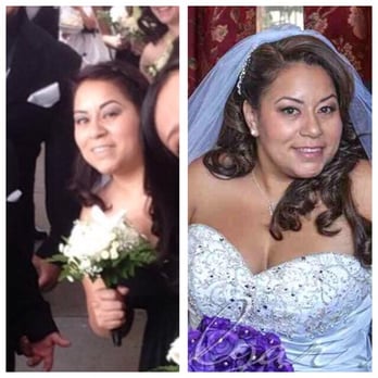 Miramar Lasik Center - Before and after my surgery to my left upper eyelid! - Optometrists Near Me - Camarillo, California Miramar Lasik Center - Before and after my surgery to my left upper eyelid! - Optometrists Near Me - Camarillo, California