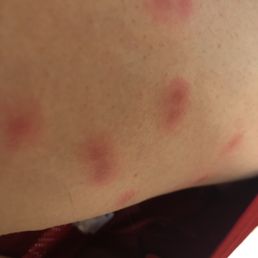 Bed bugs... Bed bugs...