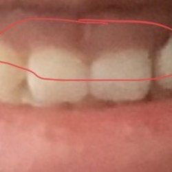 Richard F Amato, DDS-Advanced Perio - Before procedure