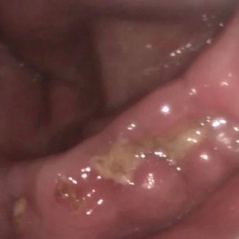 Dental Nook - Mouth infection - Pediatric Dentists Near Me - Carindale, QLD