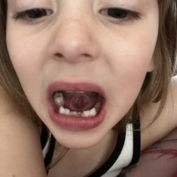 Rocklin Kids Dentist - Laser tongue release. She is already speaking clearer in js a few hours