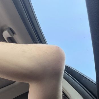 Downtown Barbecue - Fluid around my elbow- Boritis. - Barbeque Near Me - Santa Rosa, California Downtown Barbecue - Fluid around my elbow- Boritis. - Barbeque Near Me - Santa Rosa, California