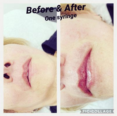 Lip Fillers - Zero downtime no needles no pain lip fillers with hyaluronic pen have a beautiful lips without no pain￼