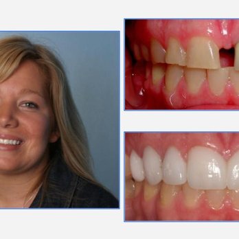 Southern Dental - Sara - Stunning new smile shows how careful planning and the right dental laboratory work together to deliver amazing results! - General Dentistry Near Me - Phoenix, Arizona Southern Dental - Sara - Stunning new smile shows how careful planning and the right dental laboratory work together to deliver amazing results! - General Dentistry Near Me - Phoenix, Arizona