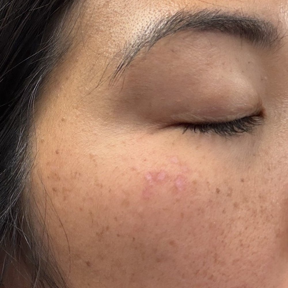 Laser spot treatment for sunspots/freckles... scarred my skin and didn't resolve my skin concerns.