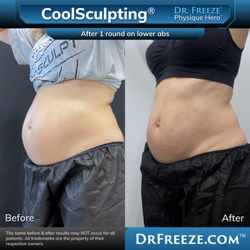 Dr. Freeze CoolSculpting Center