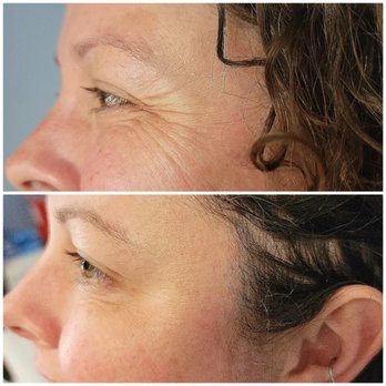 SkinMed Solution - Botox - crows feet - Medical Spas Near Me - Tucson, Arizona SkinMed Solution - Botox - crows feet - Medical Spas Near Me - Tucson, Arizona
