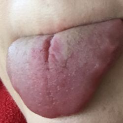 Oral & Maxillofacial Surgery PA - Fissure and tongue irritation