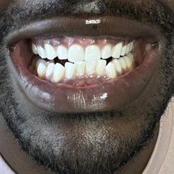 JP Teeth Whitening Service