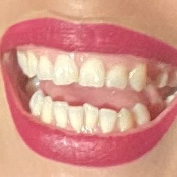 Cardinal Dental - Before. There are four teeth visibly missing here. I usually delete these photos. Someone caught me off guard this time! - General Dentistry Near Me - La Mesa, California Cardinal Dental - Before. There are four teeth visibly missing here. I usually delete these photos. Someone caught me off guard this time! - General Dentistry Near Me - La Mesa, California