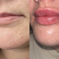 Becky Does Botox - Before and after Becky Does Botox