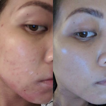 Mary Scott Skincare - Before May 10 (acne, milia, eczema) and After May 31 (clear skin, no makeup) - Skin Care Near Me - Sherman Oaks, California Mary Scott Skincare - Before May 10 (acne, milia, eczema) and After May 31 (clear skin, no makeup) - Skin Care Near Me - Sherman Oaks, California