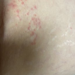 Bed bug bites Bed bug bites
