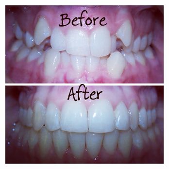Master Orthodontics - Before and after photo of our patient treated by Invisalign. If it doesn't challenge you, it doesn't change you. Be a Warrior not a Worrier. - Orthodontists Near Me - Bremerton, Washington