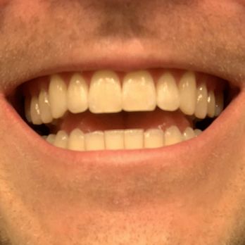 Studio Dental - After - 1 - General Dentistry Near Me - San Francisco, California Studio Dental - After - 1 - General Dentistry Near Me - San Francisco, California