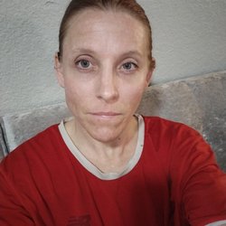 Beverly Hills Rejuvenation Center - CO 2 Laser Resurfacing and I will update in a couple weeks after my face heals from the second treatment that was done Tuesday