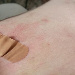 Academic Dermatology Consultants of Long Island - I had a biopsy done to find out what it is heat rash or other to find best course of treatment