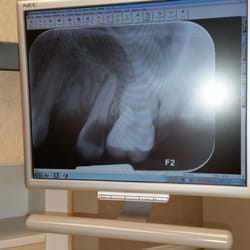 Payne & Payne Dentistry - The three teeth I had pulled.