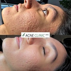 Acne Clinic
