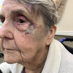 Mountain Park Memory Care - The fall where she broke her right wrist and left orbit