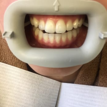 ProDental Hygiene LLC - BEFORE - General Dentistry Near Me - Portland, Oregon ProDental Hygiene LLC - BEFORE - General Dentistry Near Me - Portland, Oregon