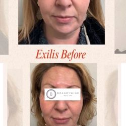 Brandywine Med Spa - EXilis Radiofrequency and Ultrasound energy treatment.