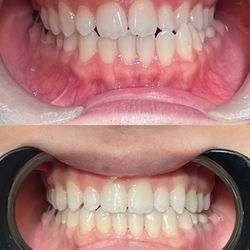 Invisalign