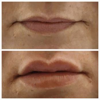T Med Spa - Restylane lip filler $375 - Medical Spas Near Me - Boca Raton, Florida T Med Spa - Restylane lip filler $375 - Medical Spas Near Me - Boca Raton, Florida