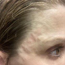 The Kaplan Center for Plastic & Reconstructive Surgery - Terrible result from filler injection at The Kaplan Center