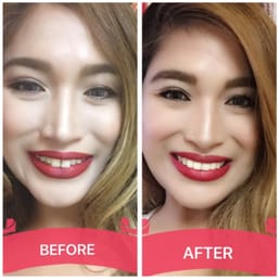 A Life changing smile make over that Dr. Precilyn Silvestre-Melo done. A Life changing smile make over that Dr. Precilyn Silvestre-Melo done.