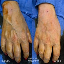 New York Plastic Surgical Group - Fat Grafting to the hand by Dr. Noel Natoli