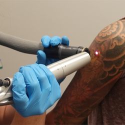 Removery Tattoo Removal & Fading