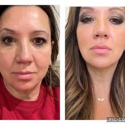 Precision Aesthetics - Before and after my brow lift with Botox, Kybella in jaw and cheek fillers.