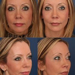 Ronald H. Schuster, MD - Before & After Filler Treatment