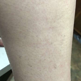 Simply Beauty - Hair Removal Near Me - Rolling Meadows, Illinois Simply Beauty - Hair Removal Near Me - Rolling Meadows, Illinois