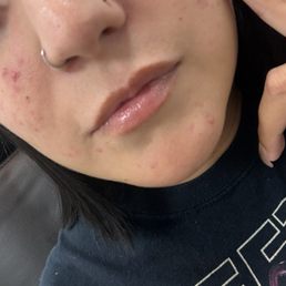 Before Lip Filler Before Lip Filler