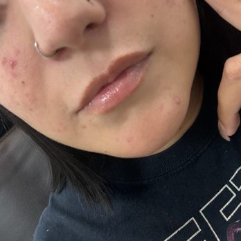 NakedMD - Before Lip Filler - Medical Spas Near Me - Las Vegas, Nevada NakedMD - Before Lip Filler - Medical Spas Near Me - Las Vegas, Nevada
