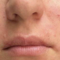 nood wax & sugar - Burns and bumps 3 days later