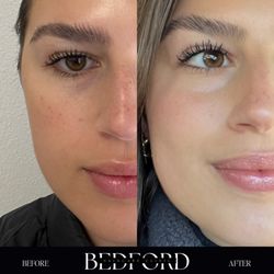 VI Peels Results