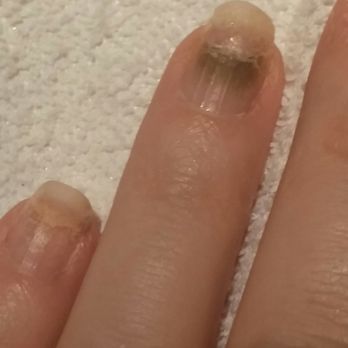 Delray Nails & Spa - Infected and cracked nail from Delray Nails & Spa.  DO NOT GO THERE! - Nail Salons Near Me - Delray Beach, Florida