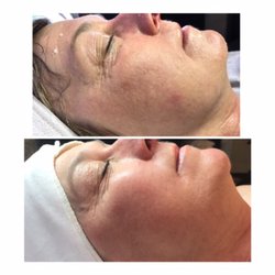 Illume Aesthetics - Radiofrequency skin resurfacing with stem cell treatment. Smooth out texture, erase wrinkles, tighten the skin
