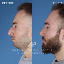 Andre Panossian, MD - Closed rhinoplasty before and after