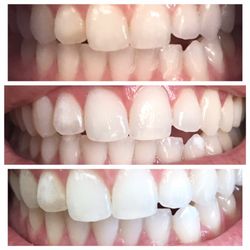 Teeth Whitening Center - 3 Hours !!