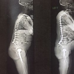 The Spine Hospital - This is when you crush the nerves to the arms and hands on purpose because you are a cruel pos