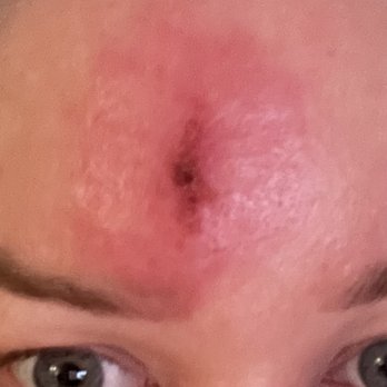 CA Yoga Barre - Staph infection - Yoga Near Me - Scottsdale, Arizona